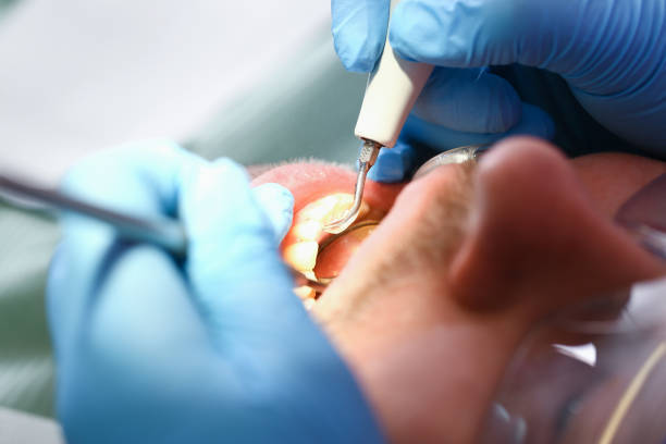 Best Broken or Cracked Tooth Emergency Dentist in Laurium, MI